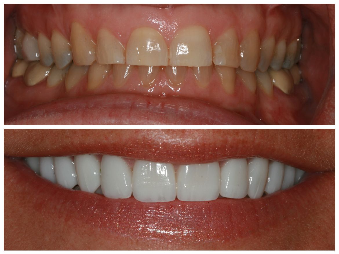 Top: Teeth before cosmetic work. Bottom: Smile transformation with bright, white teeth.