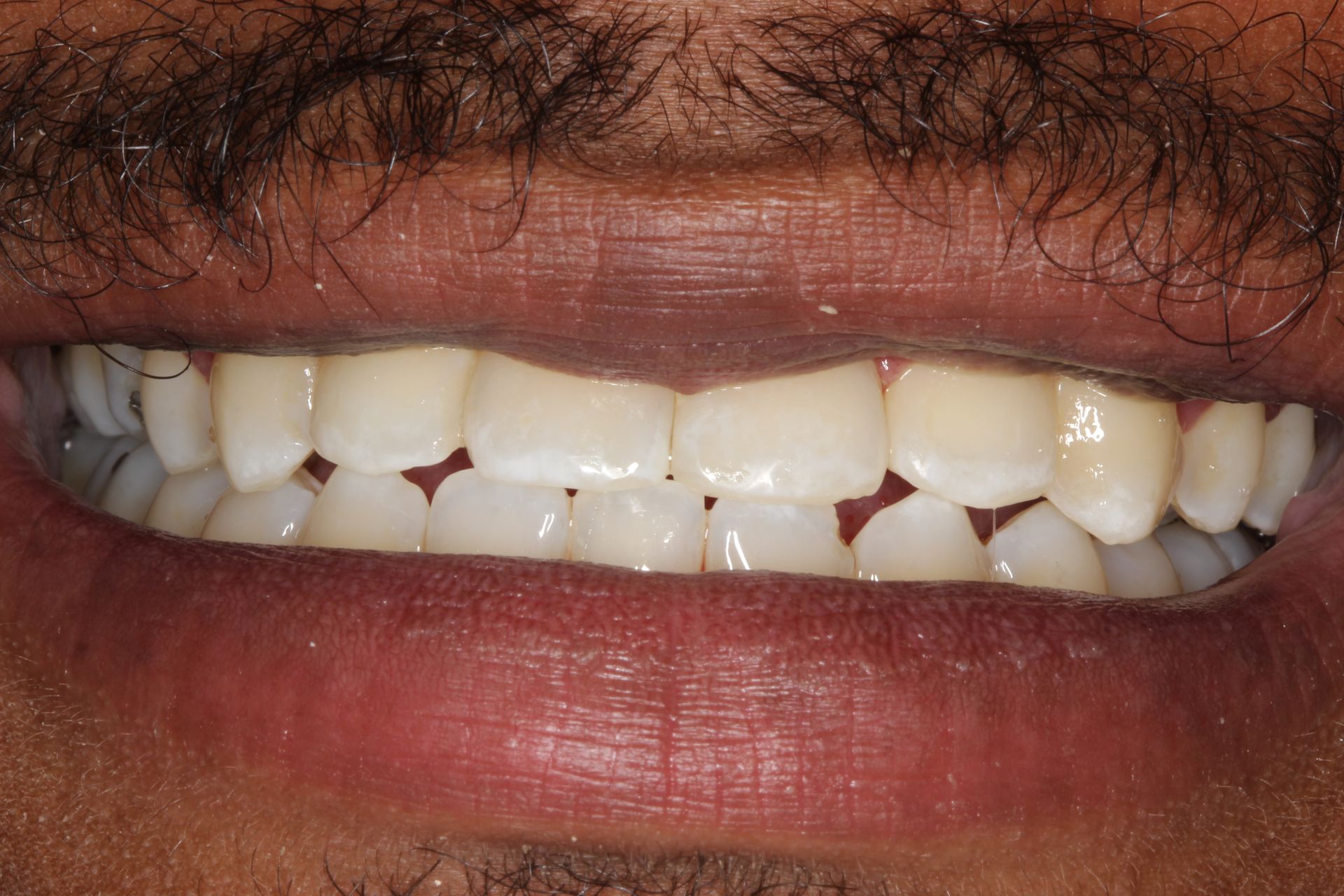 Close-up of a person's smiling mouth showing teeth and upper lip with a dark mustache.