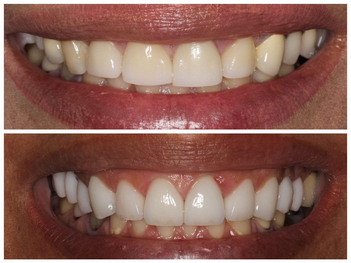 Side-by-side comparison of teeth. Top row: teeth are discolored. Bottom row: teeth are white and bright.