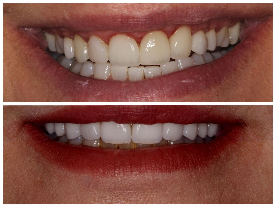 Before and after photos of a smile. Top shows uneven teeth; bottom shows a bright, even smile.