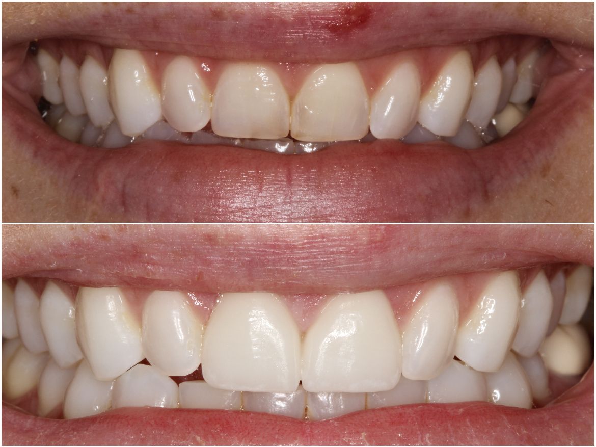Before and after photos of a person's teeth; showing a straighter, whiter smile.