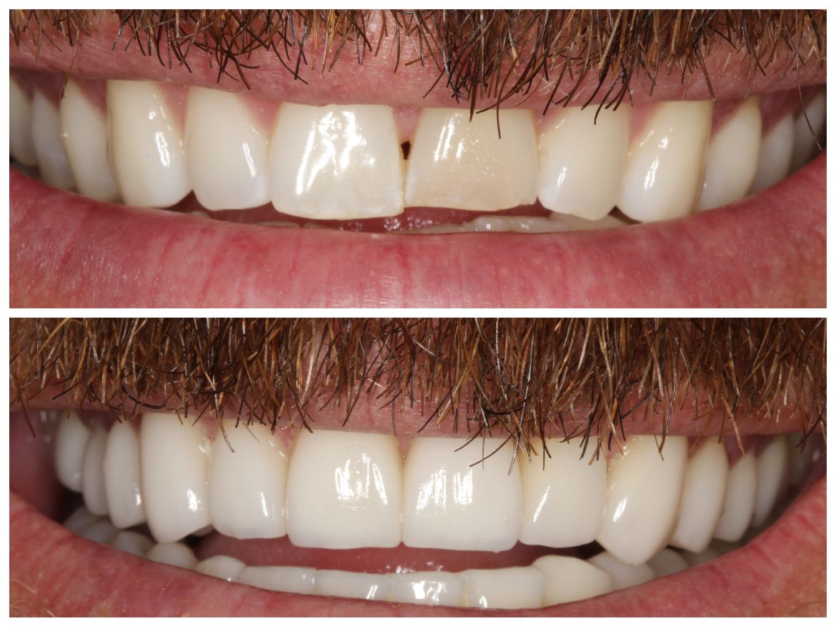 Before and after of teeth. Top row: chipped front tooth. Bottom row: repaired teeth.