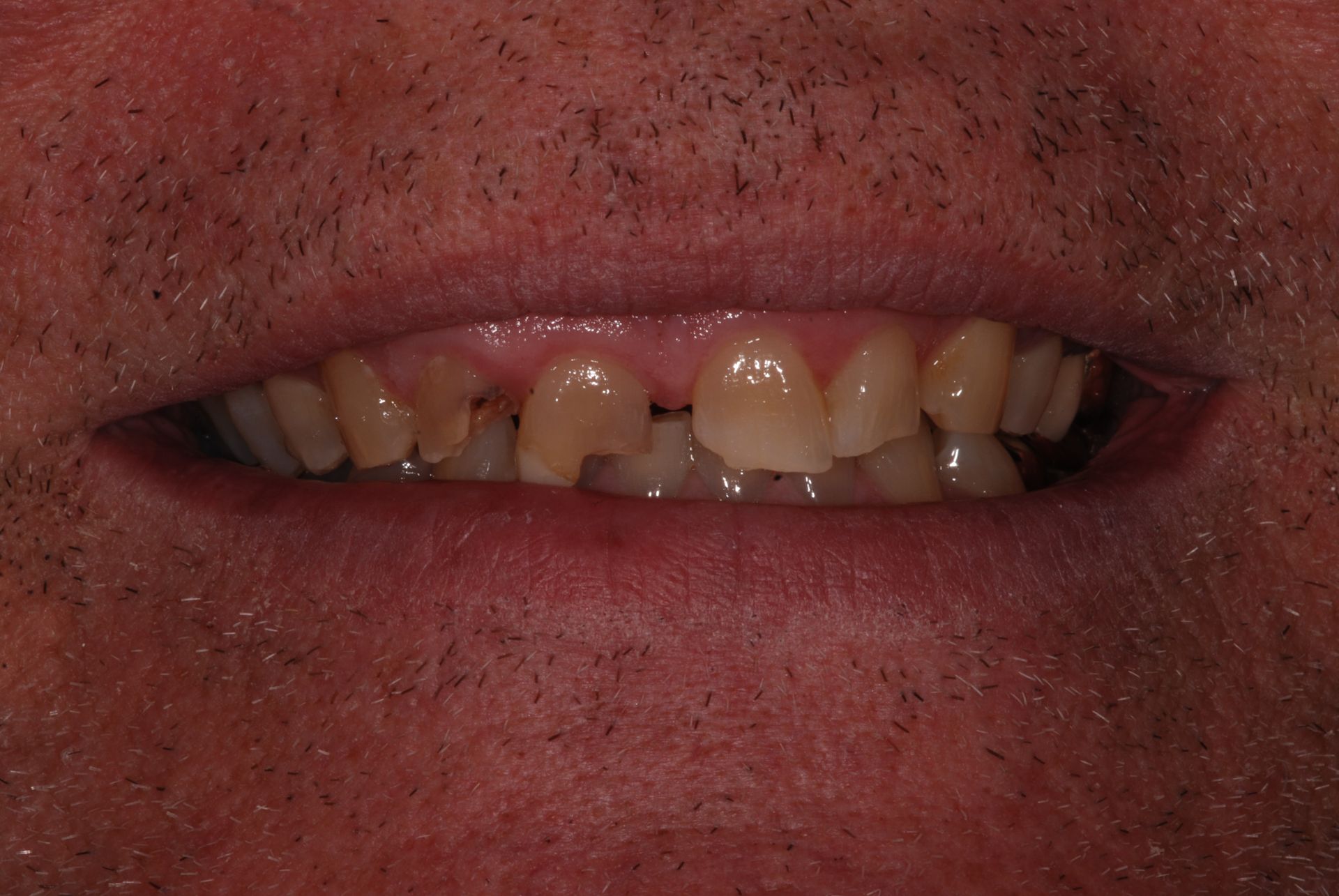 Close-up of a person's mouth with several chipped, yellowed teeth. The upper front teeth are noticeably damaged.