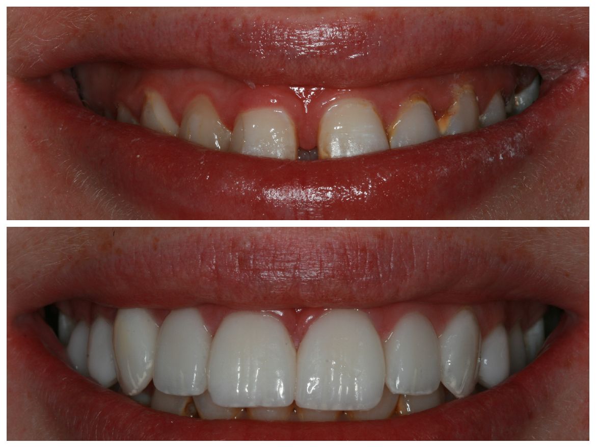 Before and after photo of teeth: the top shows a gap, the bottom shows a perfect smile.