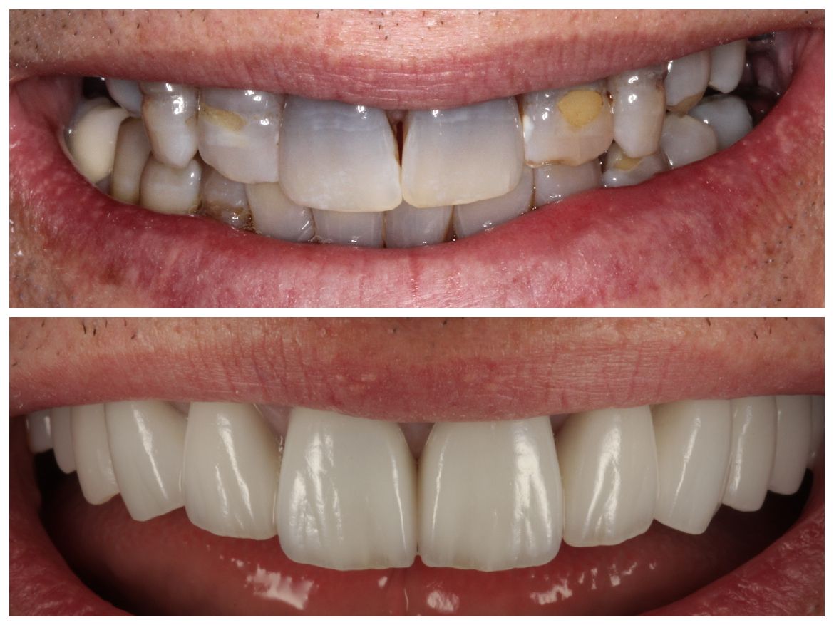 Before and after photos of a person's teeth, showing a smile with crooked, stained teeth, and then straight, white teeth.