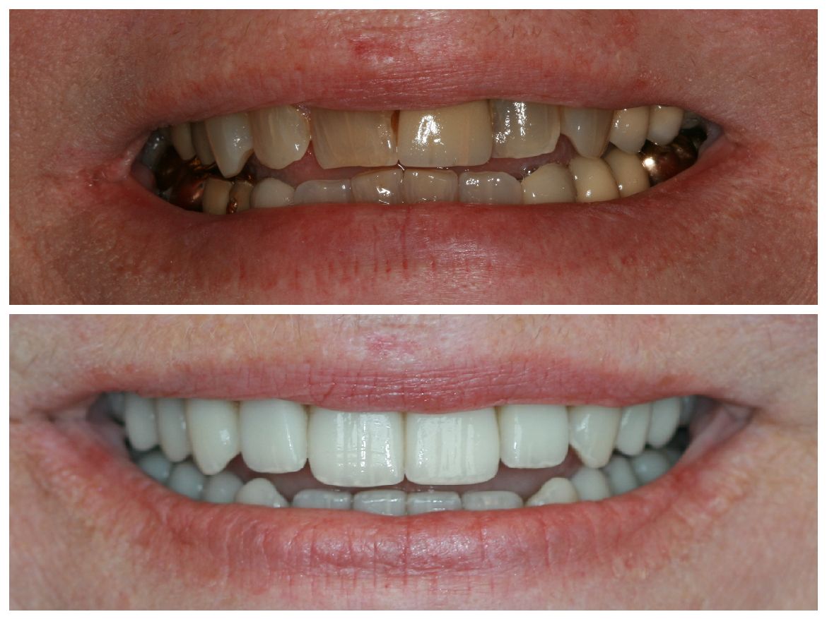 Before and after comparison of teeth. Upper image shows discolored teeth. Lower image shows bright, white teeth.