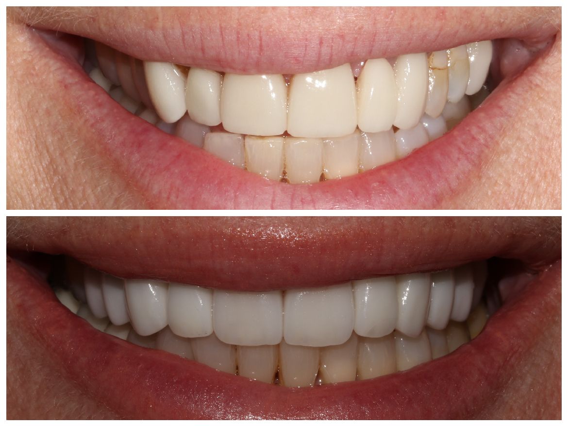 Side-by-side comparison of teeth. Top: stained teeth. Bottom: bright, white teeth after a cosmetic procedure.