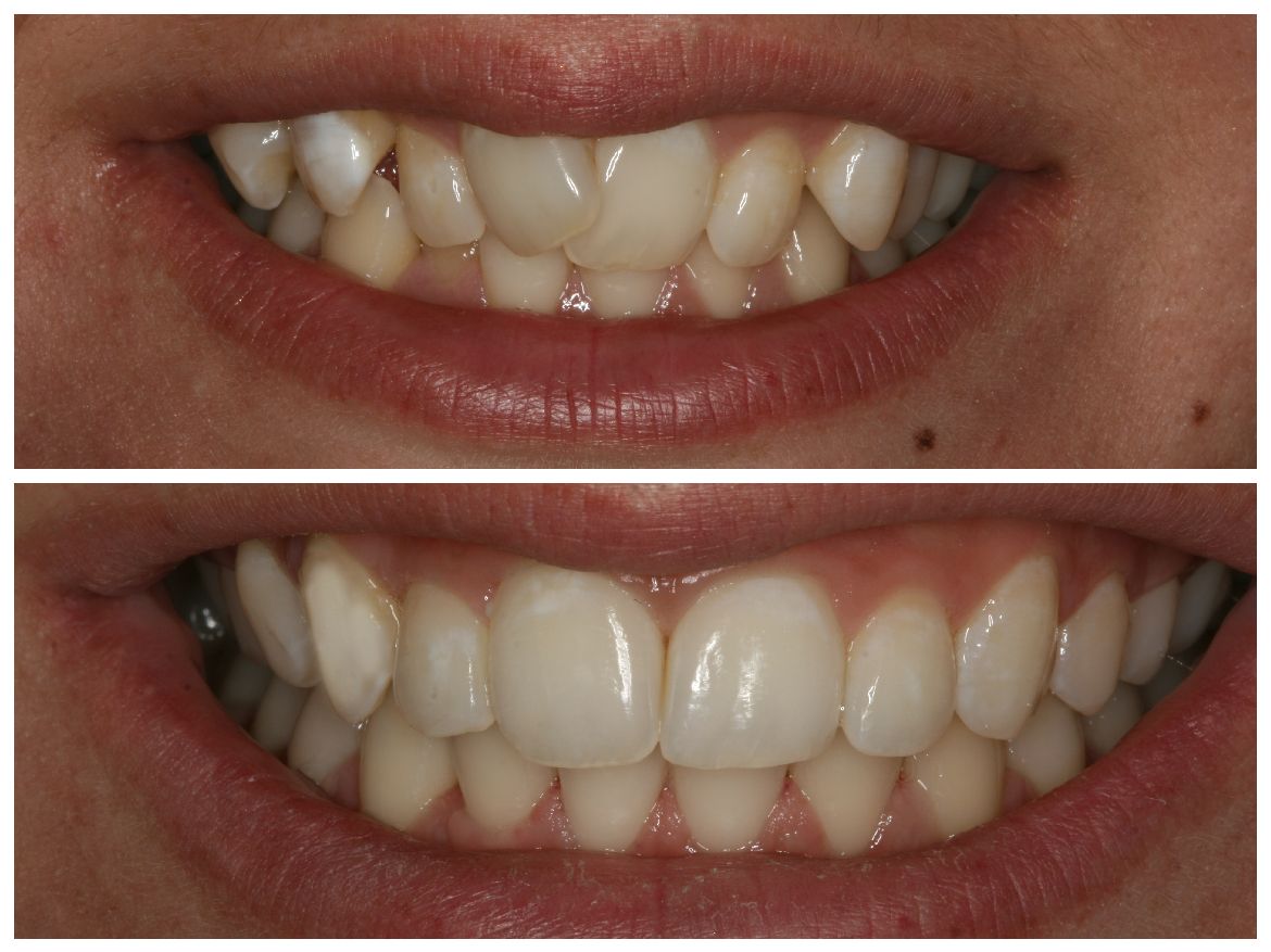 Side-by-side comparison of teeth. Top row: misaligned and discolored teeth. Bottom row: straighter, whiter teeth.