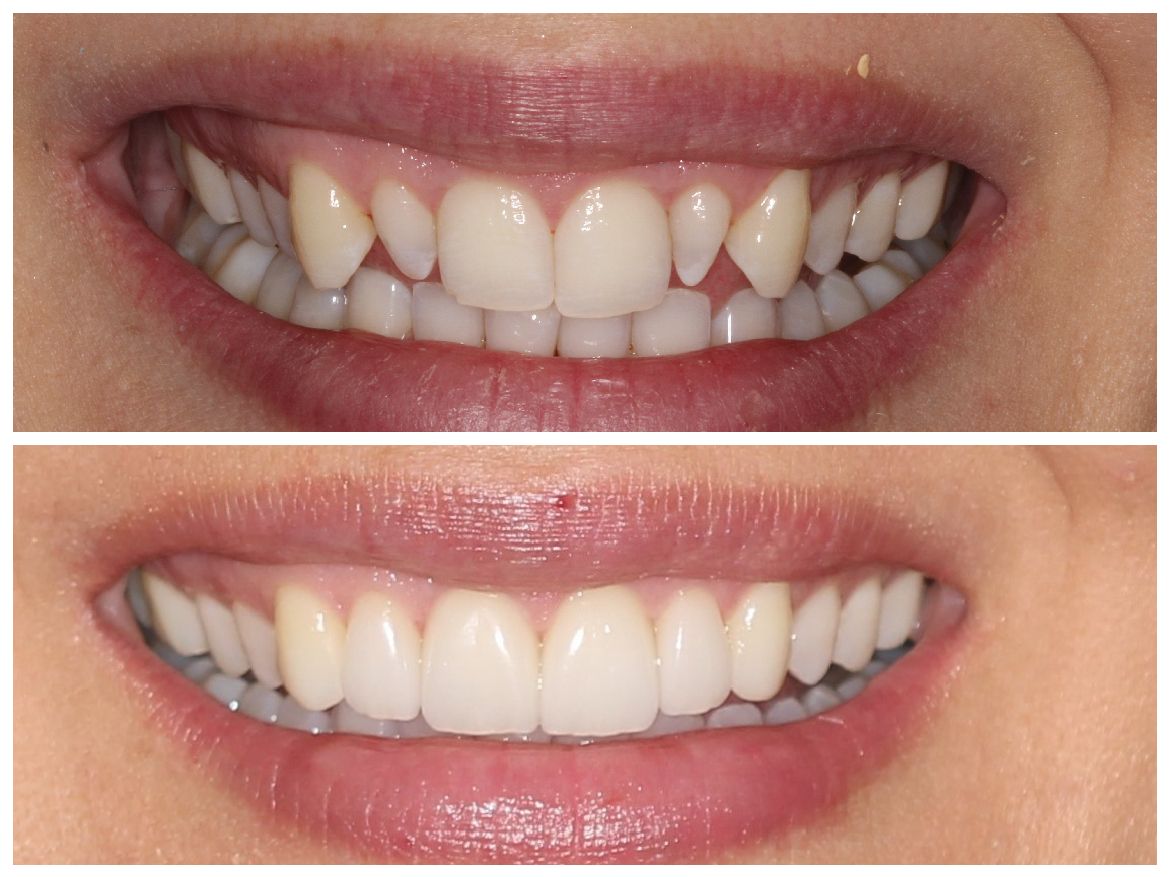 Comparison of teeth before and after dental work, showing straighter, whiter smile in the 