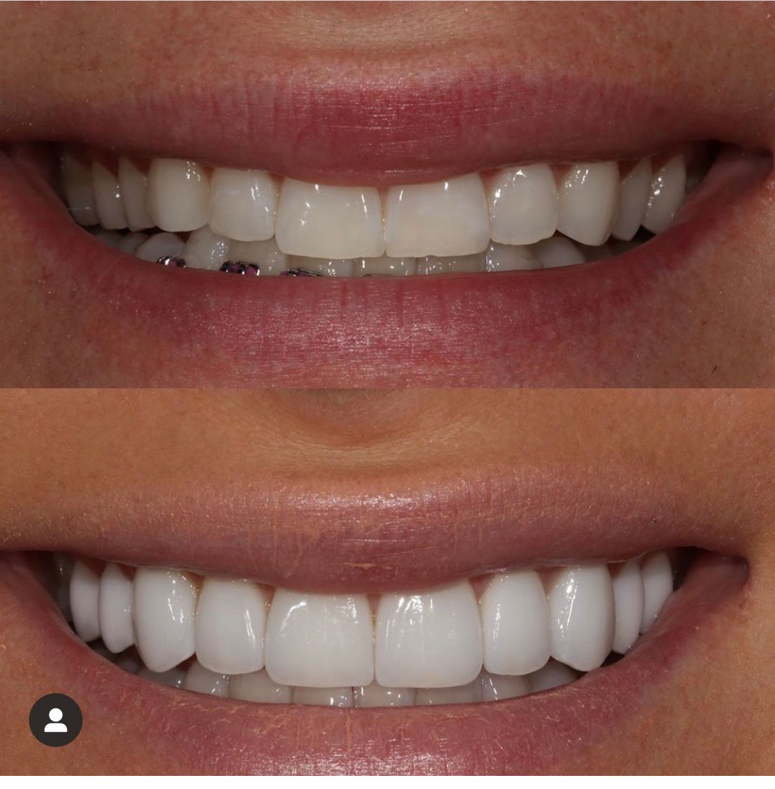Comparison of a smile before and after dental work, showing whiter, aligned teeth.
