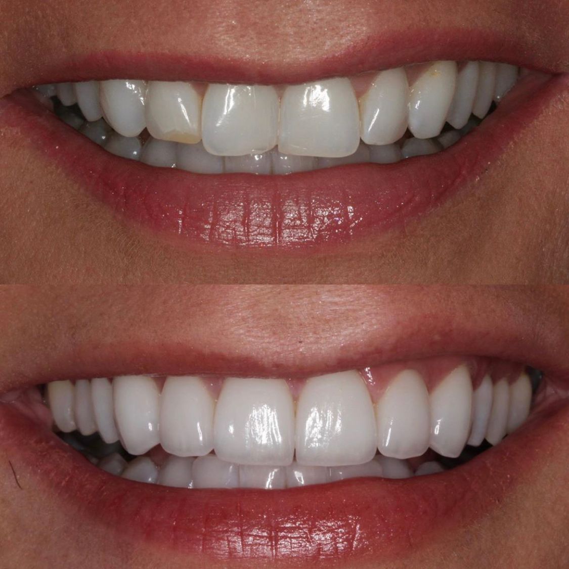 Comparison of teeth before and after cosmetic dental work, showing a brighter, more uniform smile.