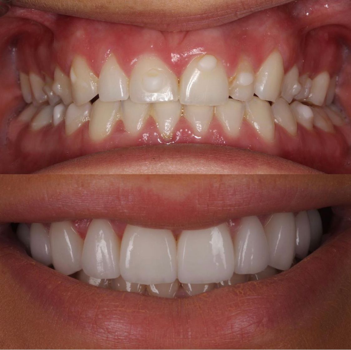 Before-and-after of teeth: upper teeth are crooked and yellow, lower teeth are straight, white, and bright.