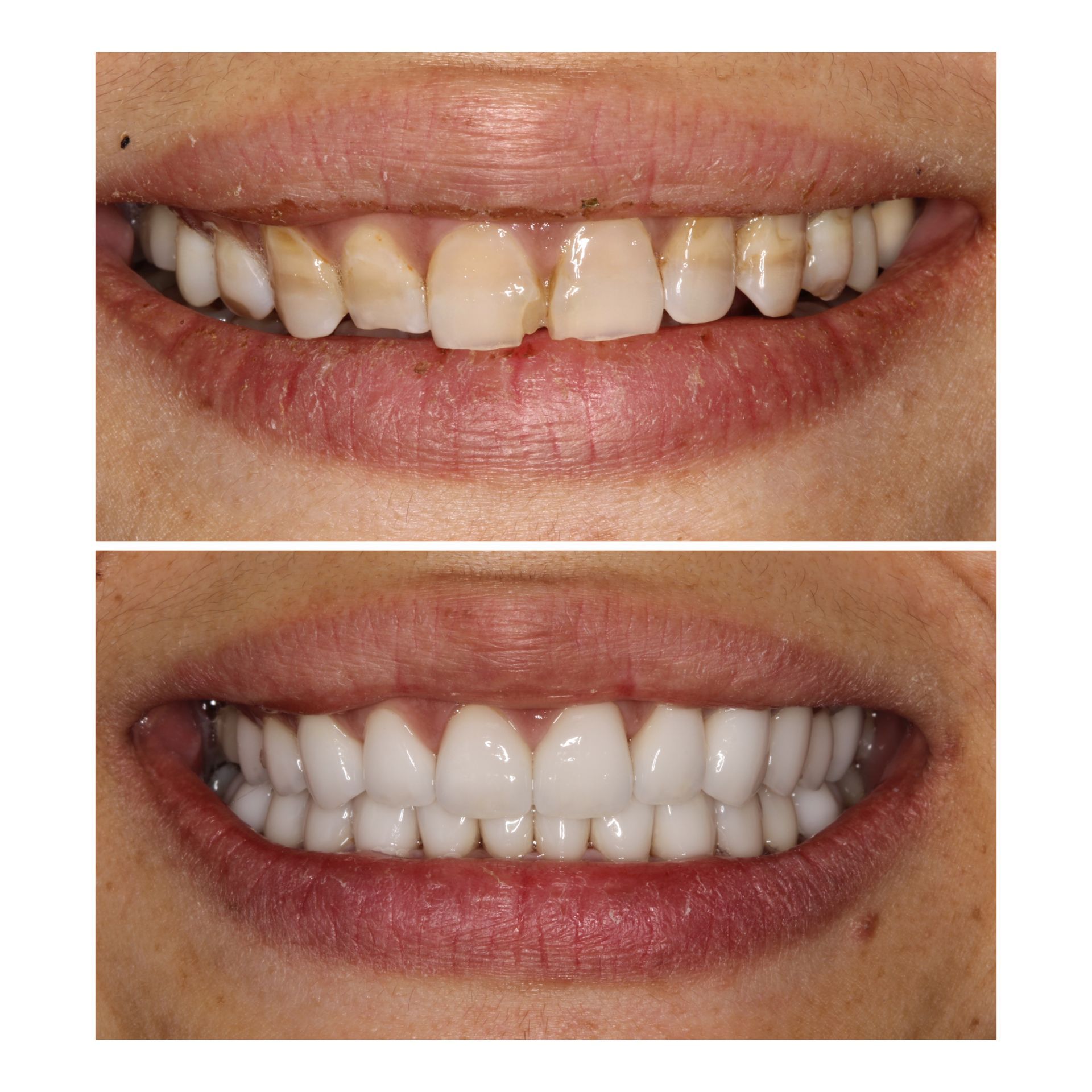 Comparison of teeth before and after dental work; before, yellowed and chipped; after, bright white and straight.
