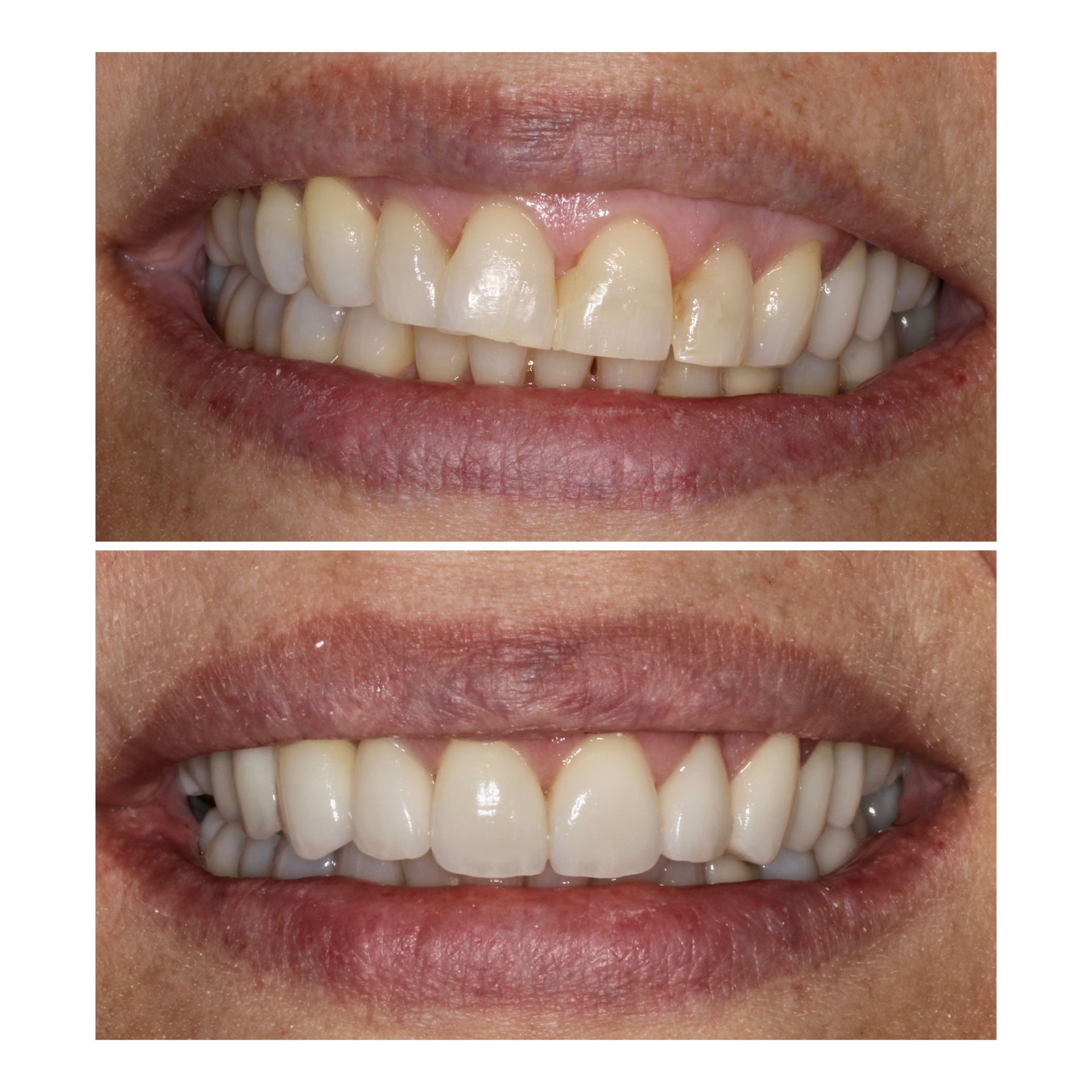 Before-and-after of a person's teeth. Top: uneven, stained. Bottom: bright, white, and even.