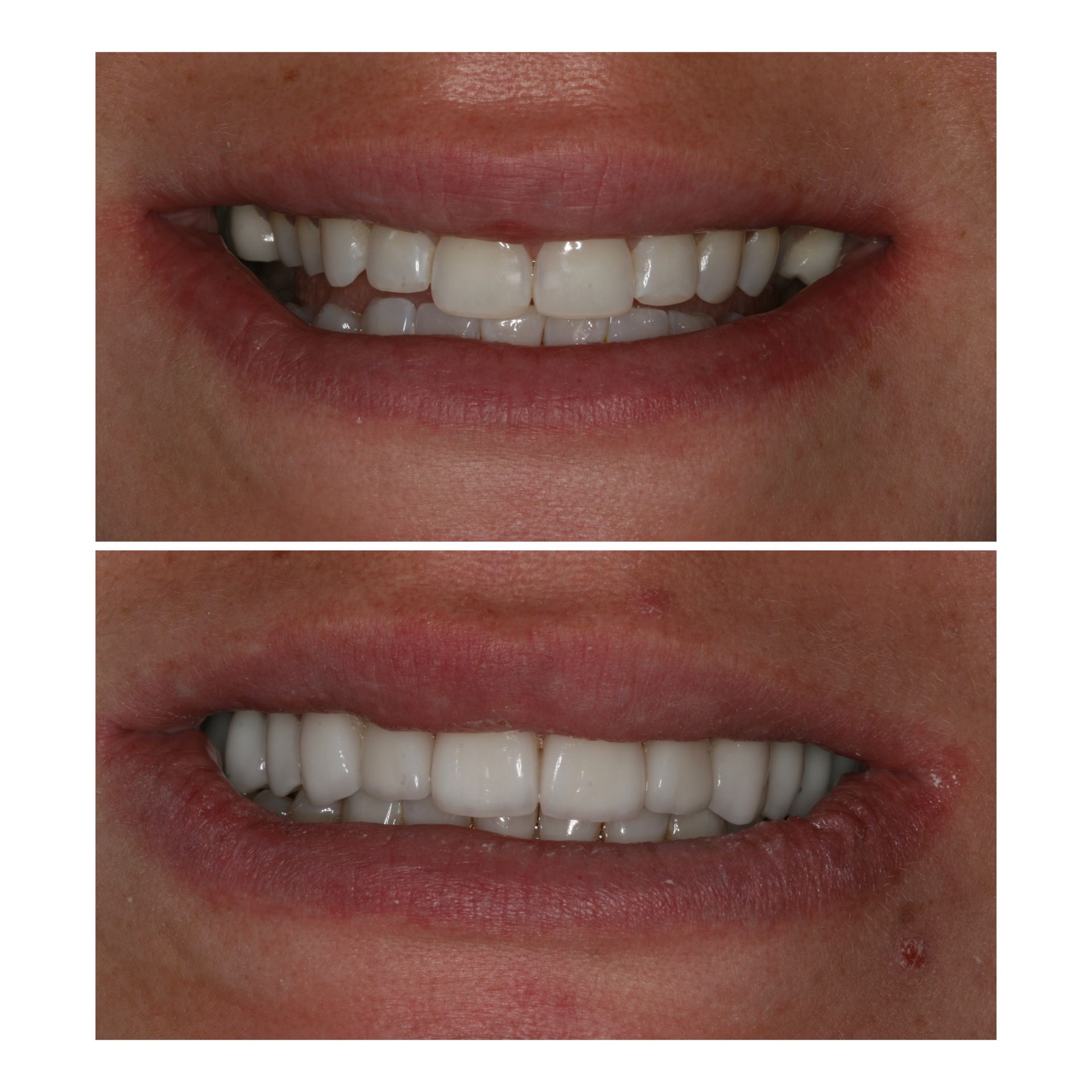 Comparison of smile before and after dental work, showing straighter, whiter teeth.