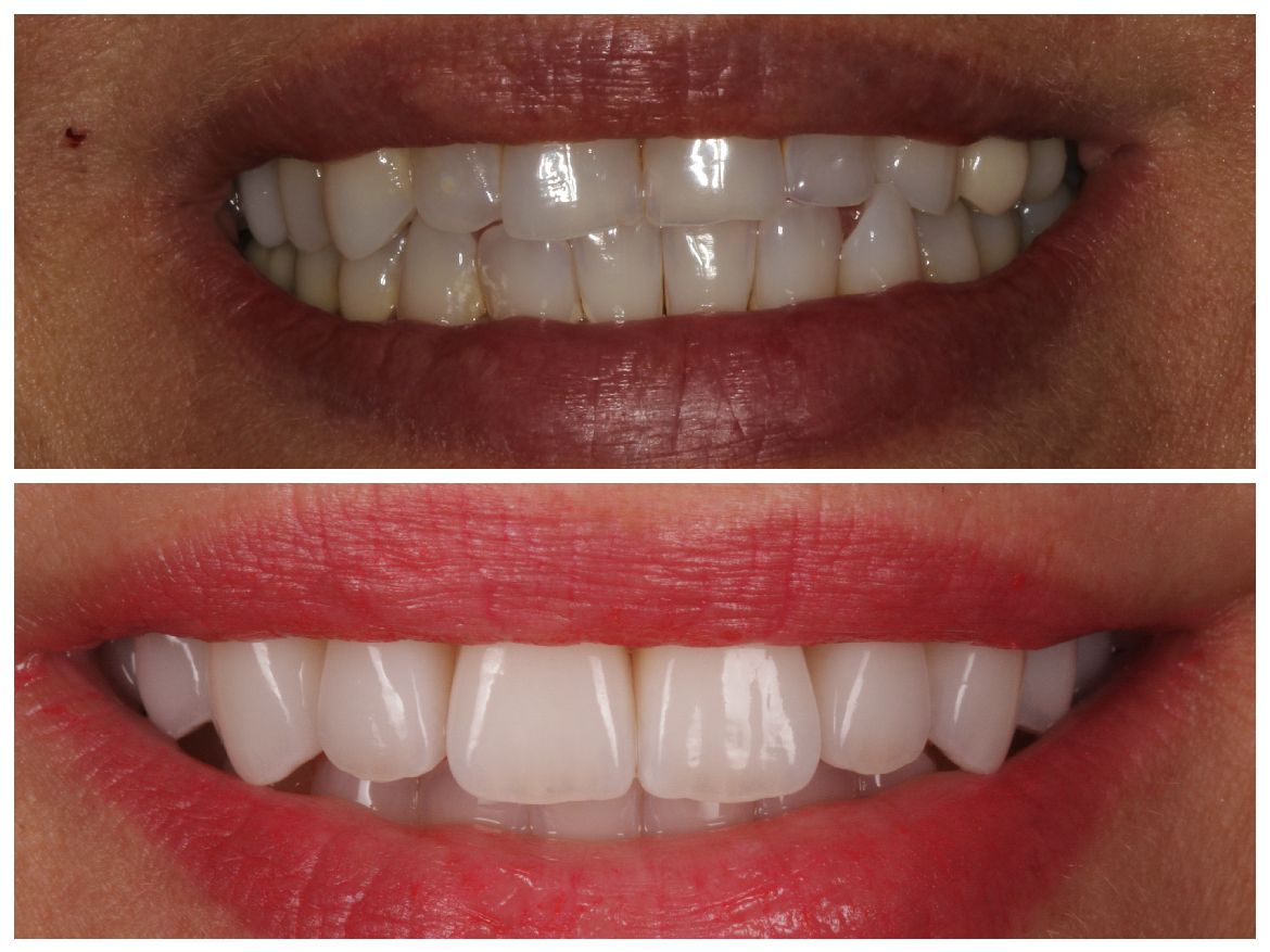 Before-and-after of a smile. Top row shows discolored teeth; bottom row reveals brighter, aligned teeth.