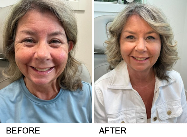 Before and after photos of a woman smiling