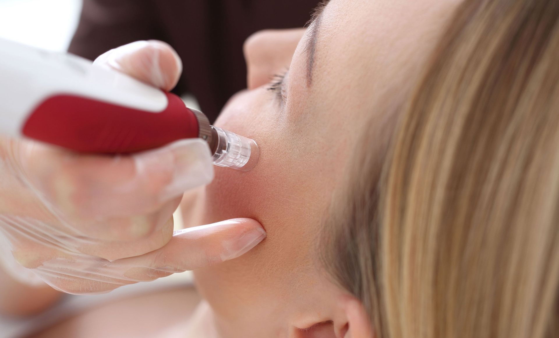 A woman receiving microneedling treatment on her cheek; red and white device, gloved hand.