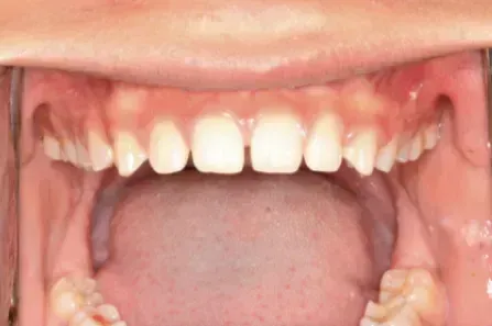 Close-up of an open mouth showing upper teeth and gums, with the tongue visible below.