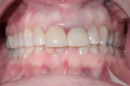 Close-up of a mouth showing upper and lower front teeth and pink gums.