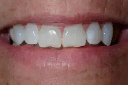 Close-up of a mouth with a gap between the front teeth and visible white teeth.