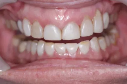 Close-up of a smiling mouth showing upper and lower teeth with lips pulled back.