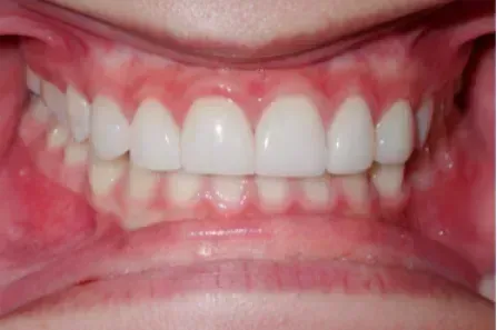 Close-up of teeth and gums with upper and lower front teeth showing.