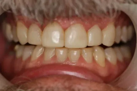 Close-up of bared teeth and gums in a wide smile, showing upper and lower teeth.