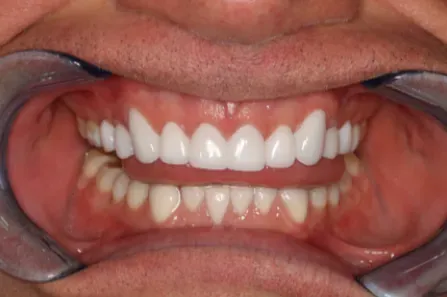 Close-up of a smiling mouth with teeth exposed using cheek retractors during a dental exam.