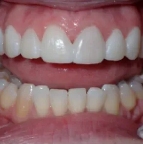Close-up of a smiling mouth showing white upper teeth and slightly yellow lower teeth.