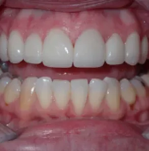 Close-up of a smiling mouth showing upper and lower teeth and pink gums.