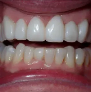 Close-up of a person's mouth showing teeth and gums with lips parted.