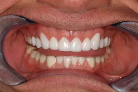 Close-up of a mouth with lips retracted, showing upper and lower teeth and gums during a dental exam.