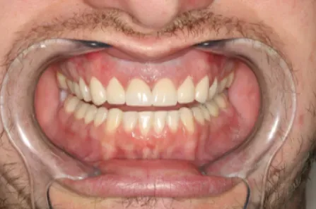 Close-up of a mouth being held open with a dental retractor, showing teeth and gums.