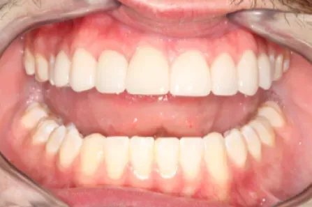 Close-up of an open mouth showing upper and lower teeth and pink gums.