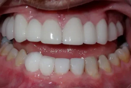 Close-up of a smiling mouth showing bright white upper teeth and slightly yellow lower teeth.