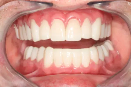 Close-up of a mouth showing upper and lower teeth with gums visible, teeth slightly parted.