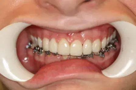 Close-up of teeth with metal braces and white cheek retractors in the mouth.