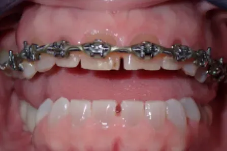 Close-up of open mouth with braces and chipped front teeth visible.