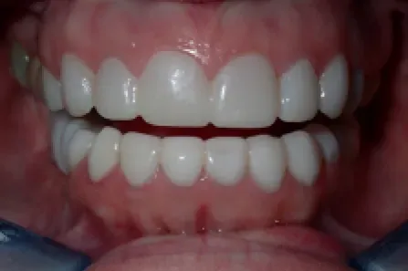 Close-up of a smiling mouth showing upper and lower teeth with a mouth retractor.