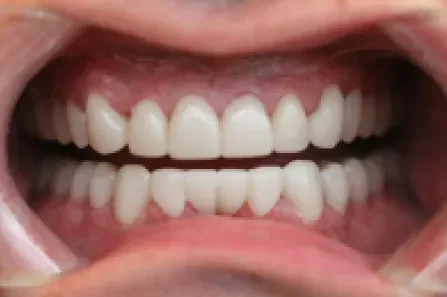 Close-up of an open mouth showing straight white teeth and pink gums.