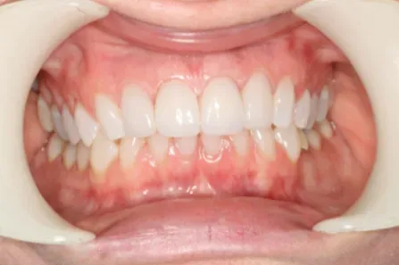 Close-up of a mouth with lips retracted, showing teeth and gums with slight discoloration.