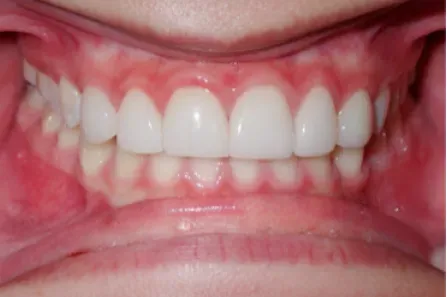 Close-up of teeth and gums with braces-like metal fixed on upper teeth and red irritation around the gums.