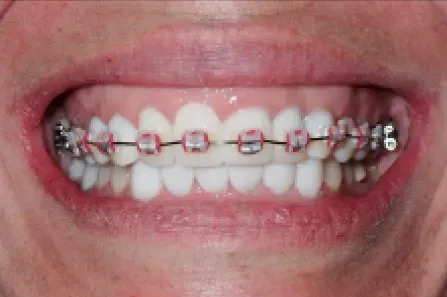 Close-up of a smiling mouth with metal braces on teeth.