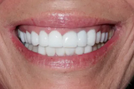 Close-up of a smiling mouth with bright white teeth and pink lips.