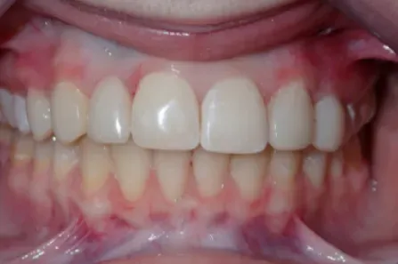 Close-up of a mouth showing upper and lower teeth and pink gums.