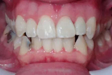 Close-up of teeth with noticeable misalignment and a gap between the front teeth.