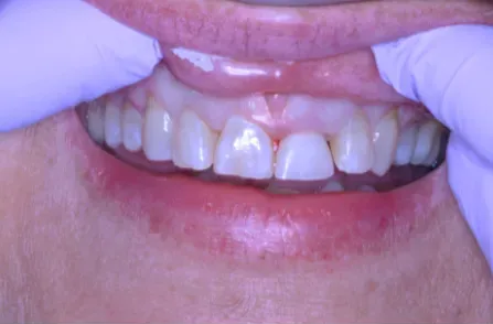 Hands pulling back lips to show upper front teeth and gums.