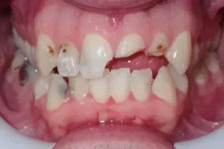 Close-up of a child's mouth with severely decayed, crowded, and missing teeth.