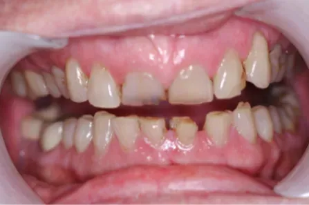 Close-up of a mouth with widely spaced front teeth and visible gaps between the teeth.